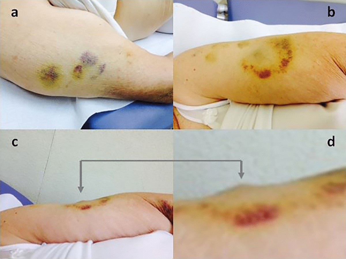 semaglutide bruise Bruising: A Neglected, Though Patient-Relevant Complication of Insulin Injections Coming to Light from a Real-Life Nationwide Survey