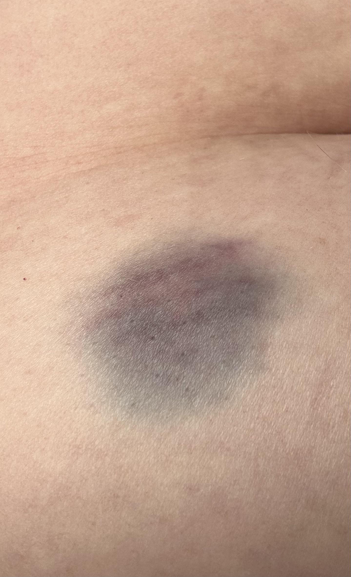 Injection site bruising : r/WegovyWeightLoss