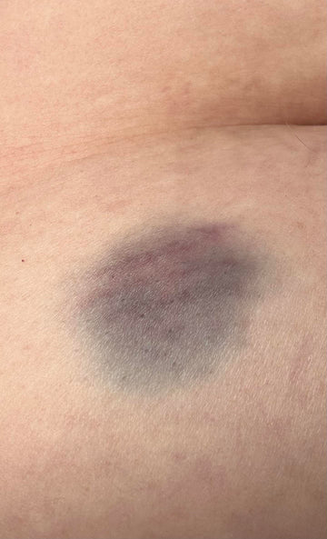 Injection site bruising : r/WegovyWeightLoss