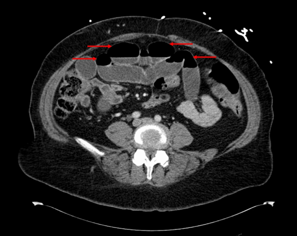 semaglutide gi obstruction legal team in dallas gastrointestinal lawyer Sandy Springs Ozempic Lawsuit Attorney semaglutide gastric intestinal obstruction law –
