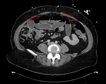 semaglutide gi obstruction legal team in dallas gastrointestinal lawyer Sandy Springs Ozempic Lawsuit Attorney semaglutide gastric intestinal obstruction law –