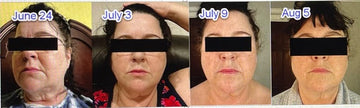 ghk cu injection before after Ghk-Cu Experienxe : r/Peptides GHKCU Skin Transformation Results After –