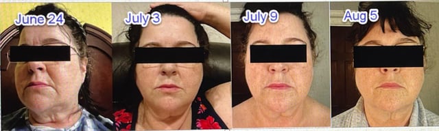 ghk cu injection before after Ghk-Cu Experienxe : r/Peptides GHKCU Skin Transformation Results After –