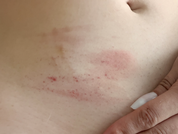 ghk-cu injection site irritation stinging sites look cooked : r/BiohackingU Ozempic Injection Burning: Causes, Prevention –