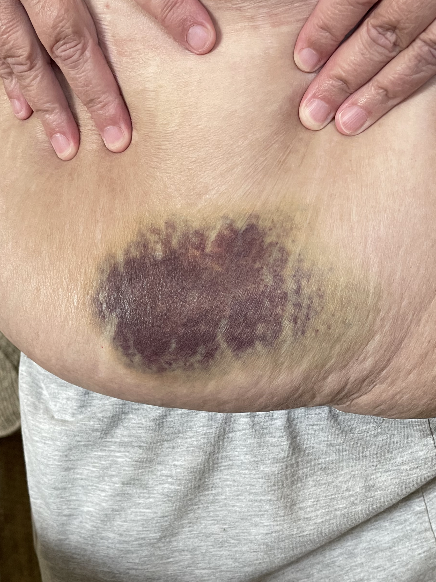 tirzepatide injection site bruise How to Avoid Bruising After Injecting — Medical Aesthetics Education Zepbound injection sites and safety –