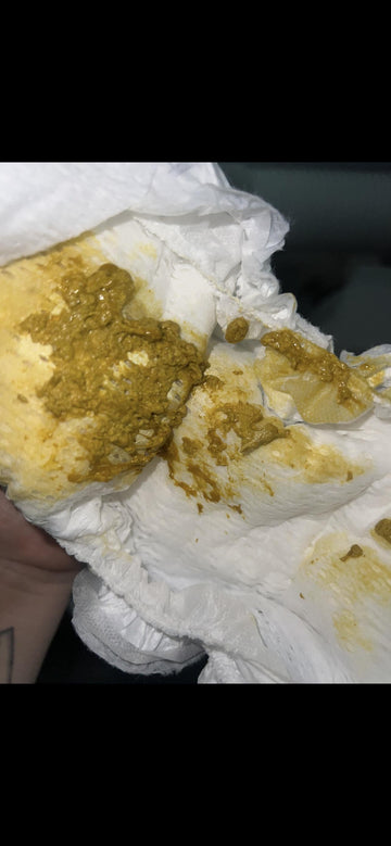 mucus stool? switched to nutramigen 8 days ago. she poops way less and it's not watery anymore, but does it still look like mucus? : r/MSPI
