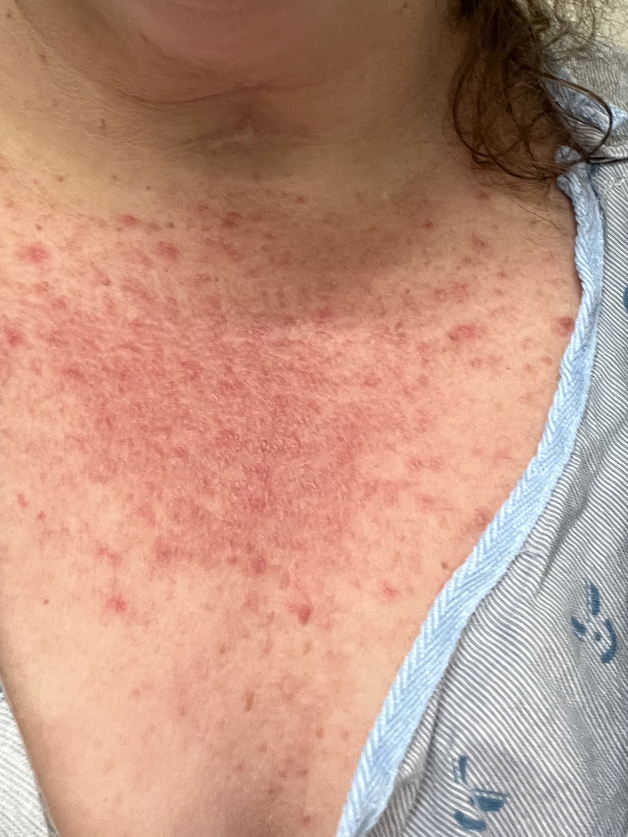 semaglutide rash Anyone else experiences hives/skin issues? : r/Ozempic Terrible rash after taking semaglutide. –