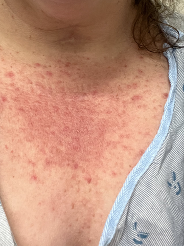 semaglutide rash Anyone else experiences hives/skin issues? : r/Ozempic Terrible rash after taking semaglutide. –